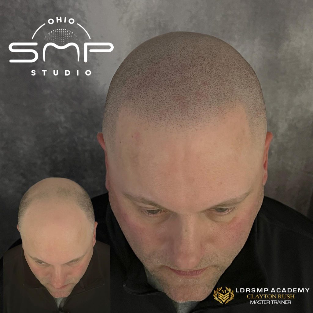 Scalp Micropigmentation: A Modern Approach to Hair Loss